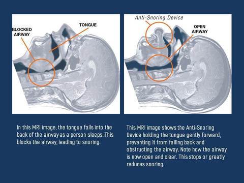 Tongue Stabilizing Device | Soft Medical-Grade Silicone & Suction Tip